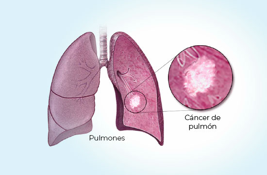 Cáncer de Pulmon